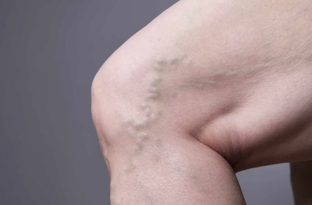 From Valve Failure to Visible Veins The Science Behind Spider Veins